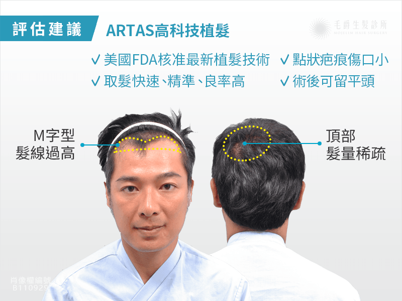 成潤植髮成功 撤底解決雄性禿困擾前額 頂部植髮artas術式 數量2912根