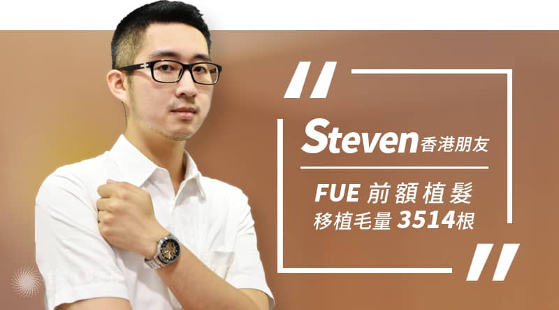 前額植髮 香港朋友steven來台植髮心聲 M字禿 Fue 植髮 毛爵生髮診所