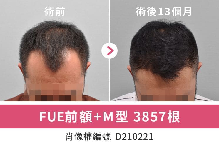 M型禿ptt常見問題懶人包 M型禿原因 落髮徵兆以及治療方法 毛爵生髮診所