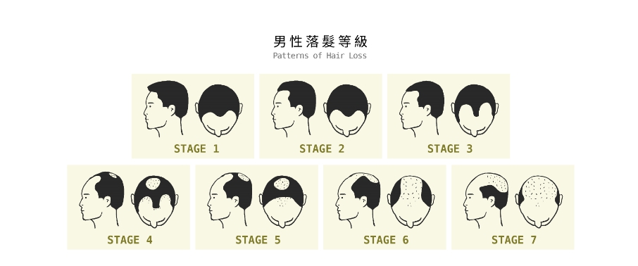 男性雄性禿掉髮禿頭階段