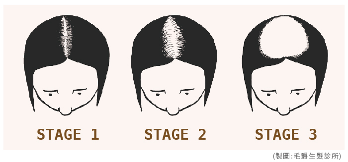 女性雄性禿掉髮禿頭階段